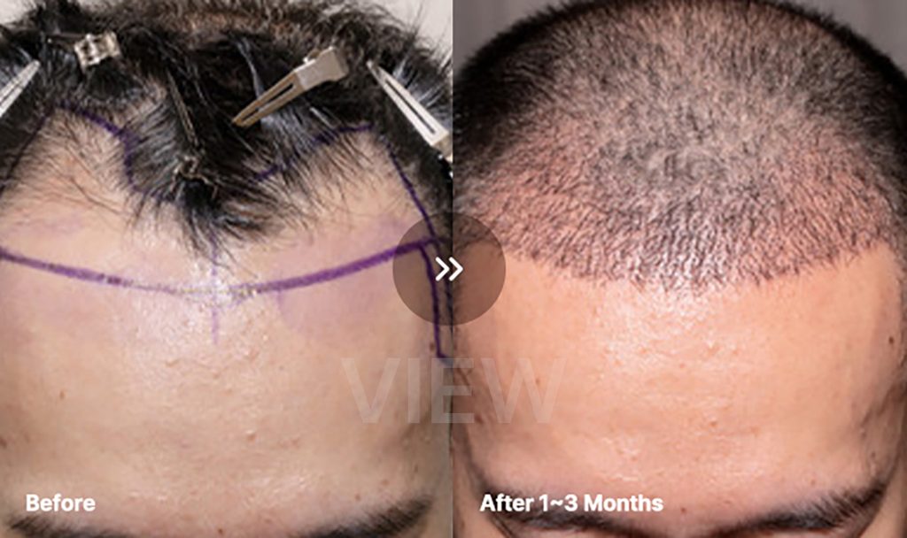 VIEW plastic surgery Hair Transplant before after 01