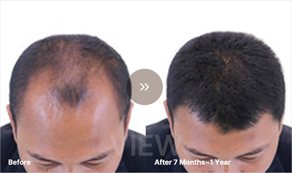 VIEW plastic surgery Hair Transplant before after 02