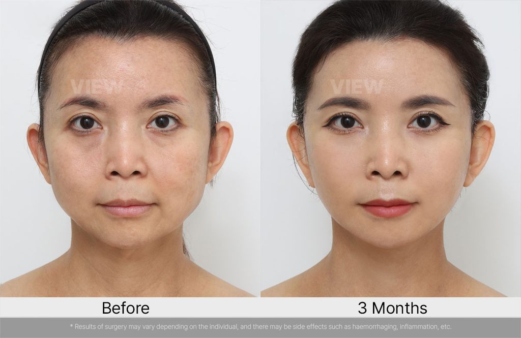VIEW Plastic Surgery Full Facelift Before After 04