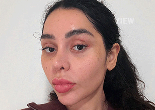 Rhinoplasty in Korea: My Real Recovery Journey at VIEW