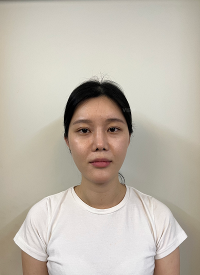 Before fat grafting surgery in Korea