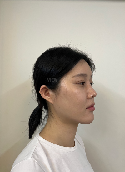 Before fat grafting surgery in Korea