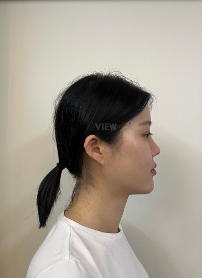 Before thread lifting in Korea