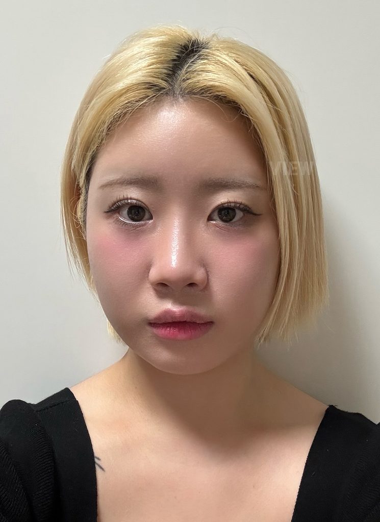canthoplasty surgery in korea