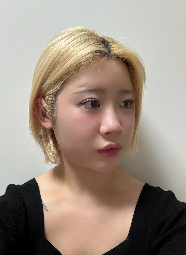nose surgery in korea