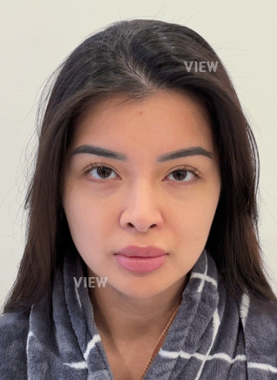 1. What made you look into plastic surgery in Korea in the first place?