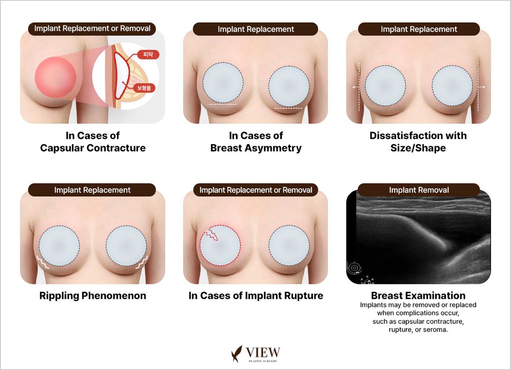 Breast Revision Surgery with Capsulectomy