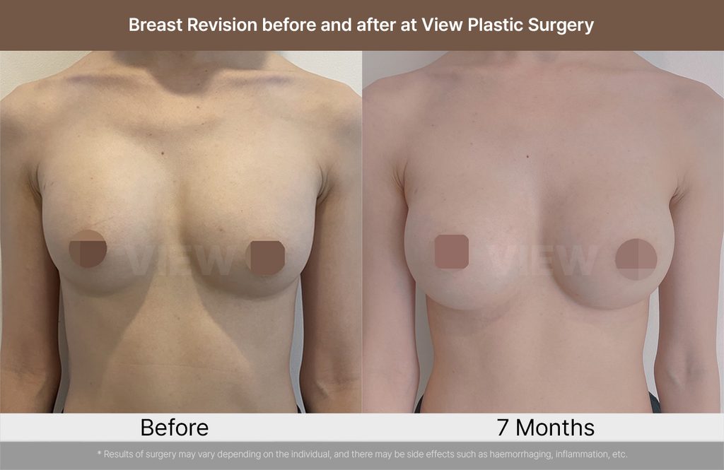 Breast Revision before and after at View Plastic Surgery 02