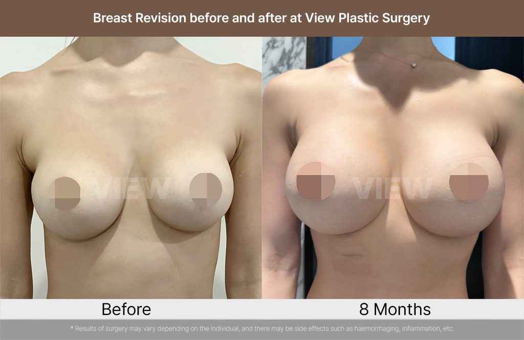 Breast Revision before and after at View Plastic Surgery 01