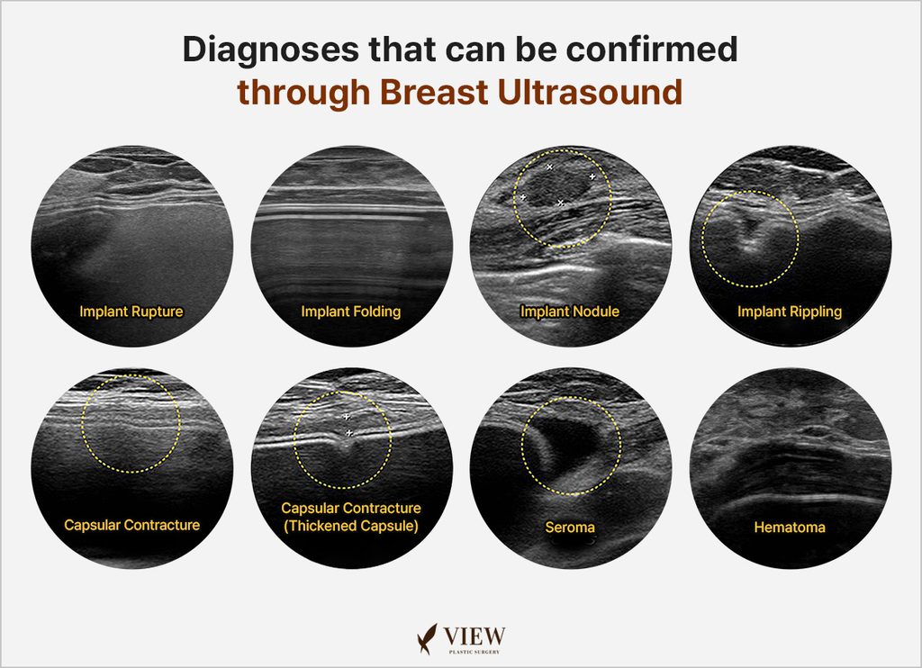 Breast Ultrasound Examination