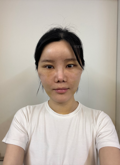 Reovery after plastic surgery in Korea