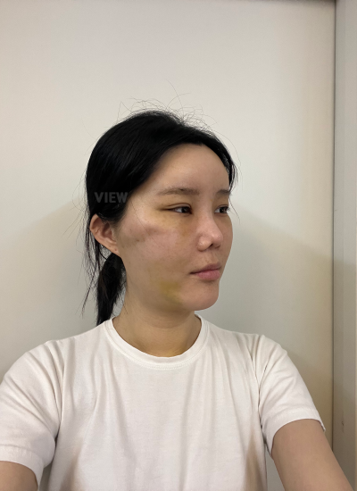 My first week finally passed, and I returned to the hospital to have my stitches removed.