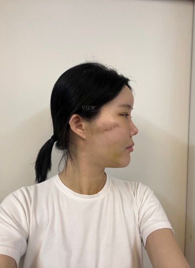 Reovery after plastic surgery in Korea
