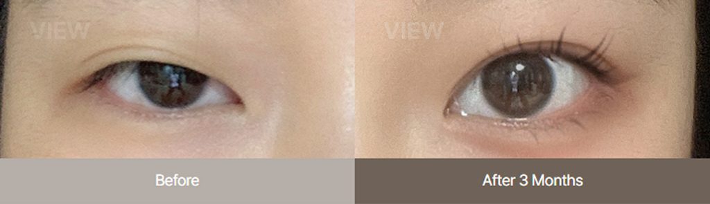 Incisional Ptosis Correction before & After 02
