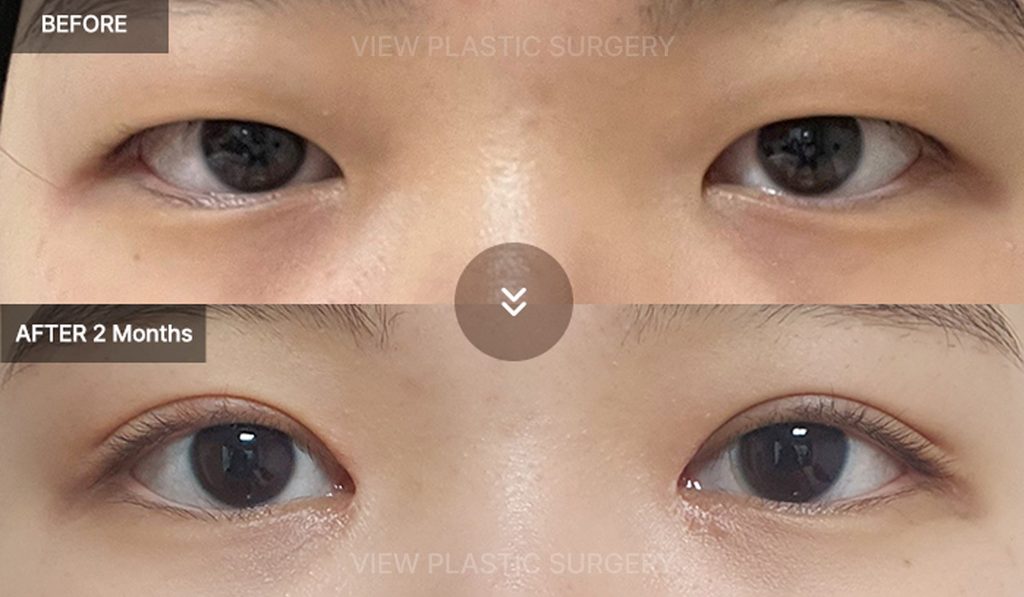 Incisional Ptosis Correction before & After
