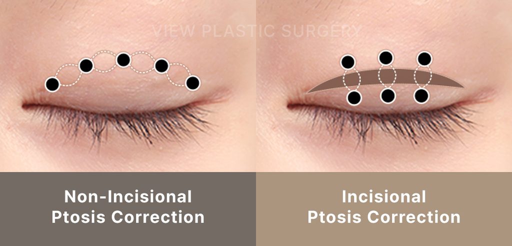 Incisional vs Non-incisional Ptosis Correction