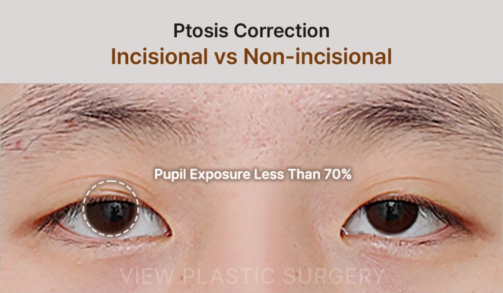 Incisional vs Non-incisional Ptosis Correction | Korea Plastic Surgery Guide