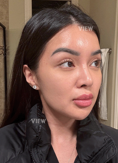 The swelling was gone, and there was only slight redness at the incision sites.