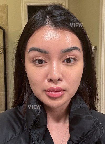 6. What about one month after surgery?