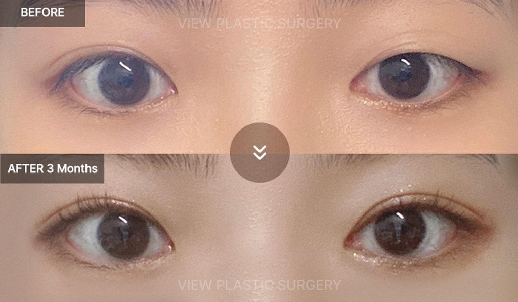 Non-Incisional Ptosis Correction before & After