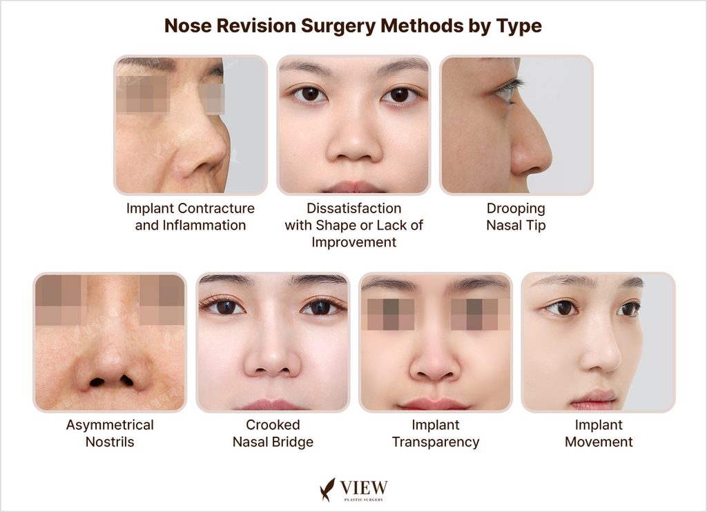 Nose Revision Surgery Methods by Type