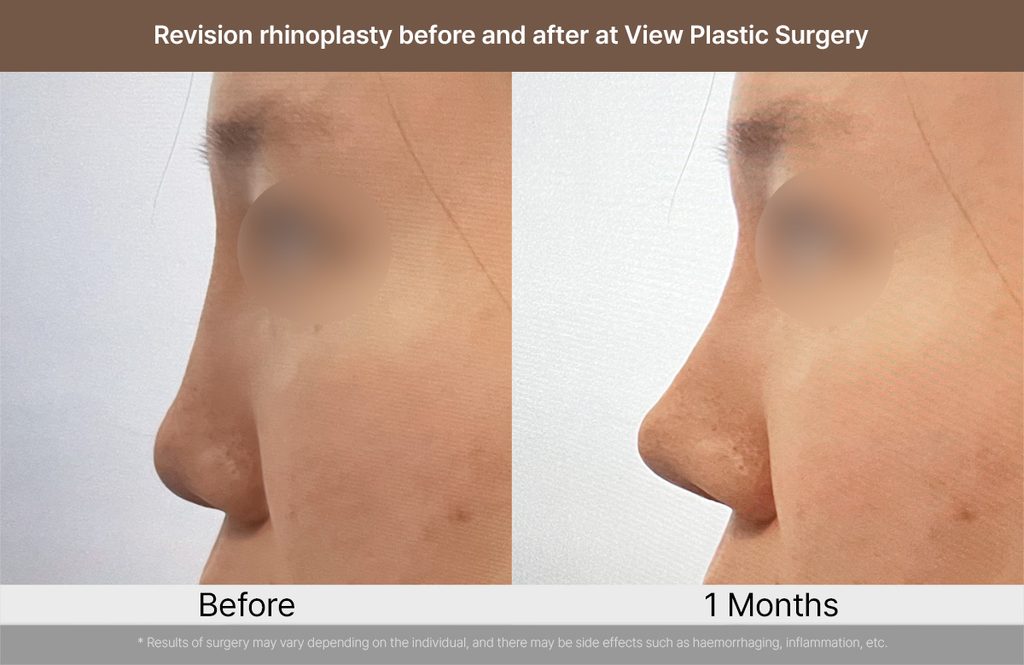 Revision rhinoplasty before and after at View Plastic Surgery 01