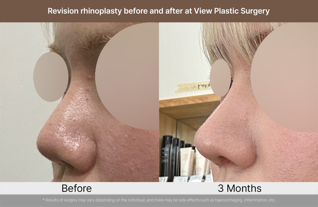 Revision rhinoplasty before and after at View Plastic Surgery 02