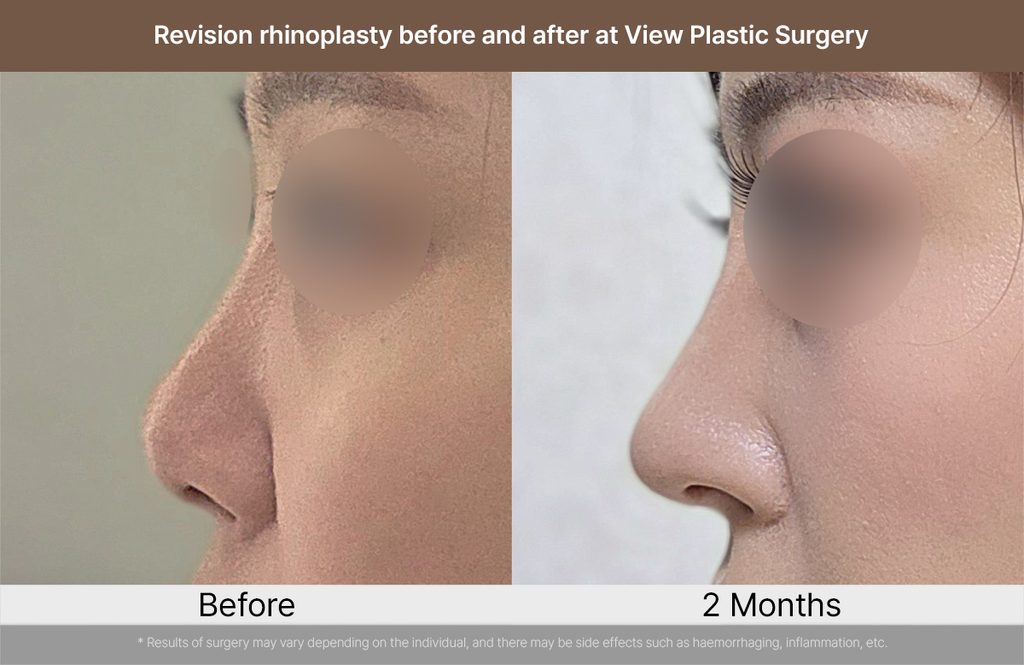 Revision rhinoplasty before and after at View Plastic Surgery 04