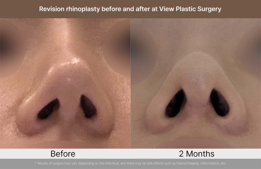 Revision rhinoplasty before and after at View Plastic Surgery 03