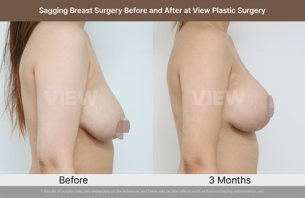 Sagging Breast Surgery Before and After