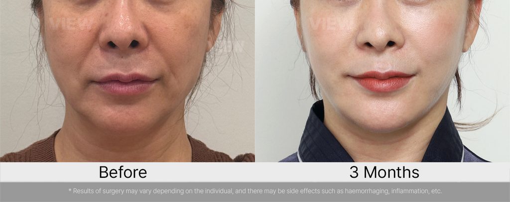 VIEW plastic surgery Marionette Lines Facelift and Fat Grafting Before and After 01