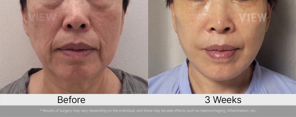 VIEW plastic surgery Marionette Lines Facelift and Fat Grafting Before and After 02