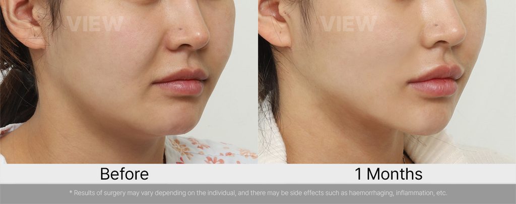 VIEW plastic surgery Marionette Lines Facelift and Fat Grafting Before and After 03