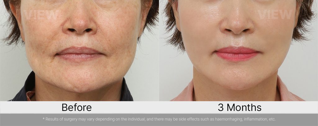 VIEW plastic surgery Marionette Lines Facelift and Fat Grafting Before and After 04