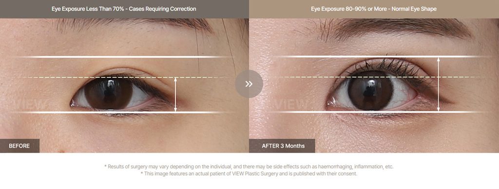 What is Ptosis Correction