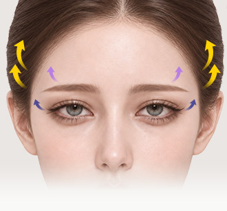 Model’s face with arrows showing the planned lifting direction of the outer brow and eye area in Fox Eyes Lift design