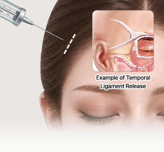 Endoscope at the hairline with an inset illustration of the temporal ligament release area
