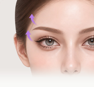 Model’s outer brow and eye area with arrows showing the upward lifting direction in a Fox Eyes Lift