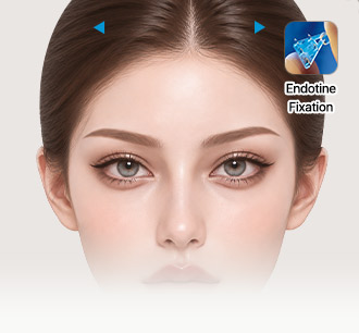Model with lifted outer brows and an inset of the Endotine device used for multi-point fixation