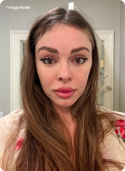5 Months after fox eyes lift in korea