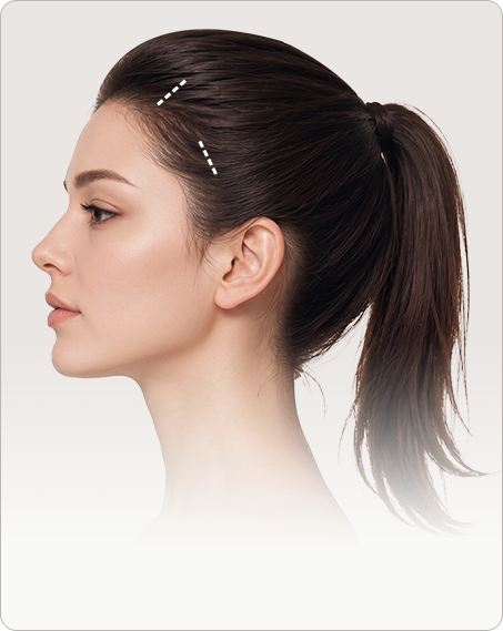 Side profile of a model with a high ponytail and red dotted lines marking the hidden hairline incision for a Fox Eyes Lift