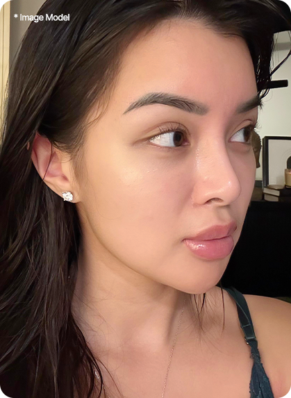 21 days after ponytail lift in korea