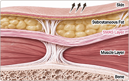 Cross-section of skin-only lifting: skin is tightened while the SMAS and deeper tissues stay in place