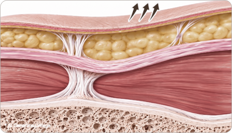 Cross-section of skin-only lifting: skin is tightened while the SMAS and deeper tissues stay in place