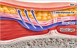 Cross-section of VIEW's Deep Plane SMAS lift, lifting the SMAS and deeper tissues together
