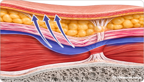 Cross-section of VIEW's Deep Plane SMAS lift, lifting the SMAS and deeper tissues together