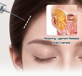 Endoscope at the hairline with an inset illustration of the retaining ligament release area