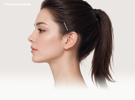 Side view of a model showing the hairline incision area for an endoscopic Ponytail Lift