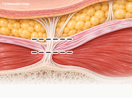 Illustration of the SMAS layer with dotted lines marking where retaining ligaments are released