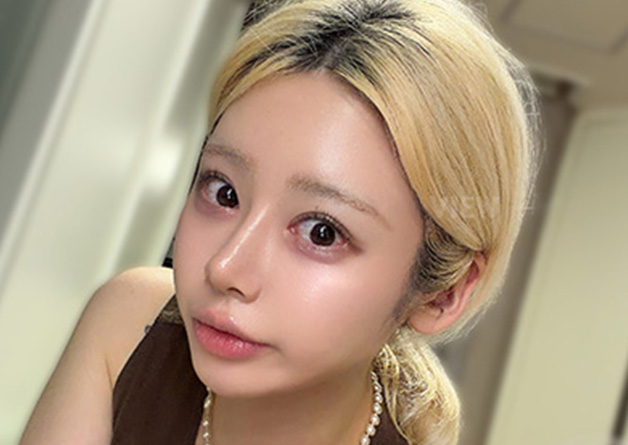 Plastic Surgery in Korea: My Revision Eyelid Surgery and Rhinoplasty Story at VIEW Plastic Surgery